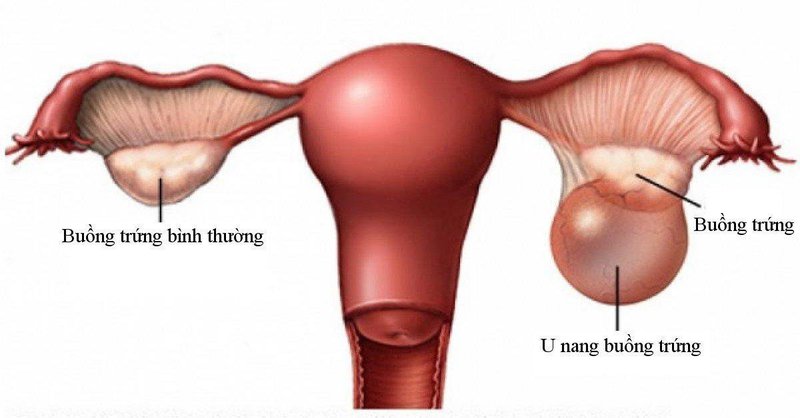 Nữ giới u nang buồng trứng điều trị như thế nào?