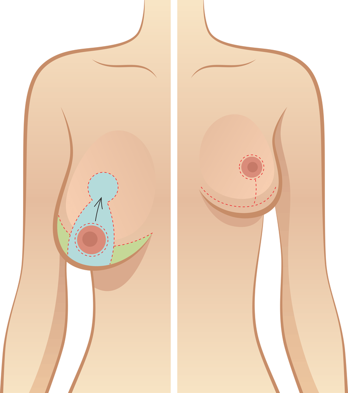 Treo ngực sa trễ có ảnh hưởng gì tới sức khỏe sau này không?