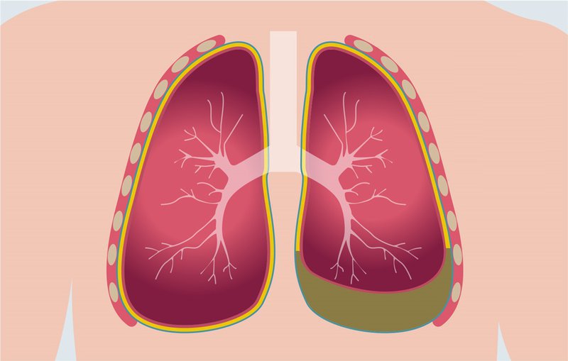 Kỹ thuật nào đánh giá tình trạng tràn dịch màng phổi?