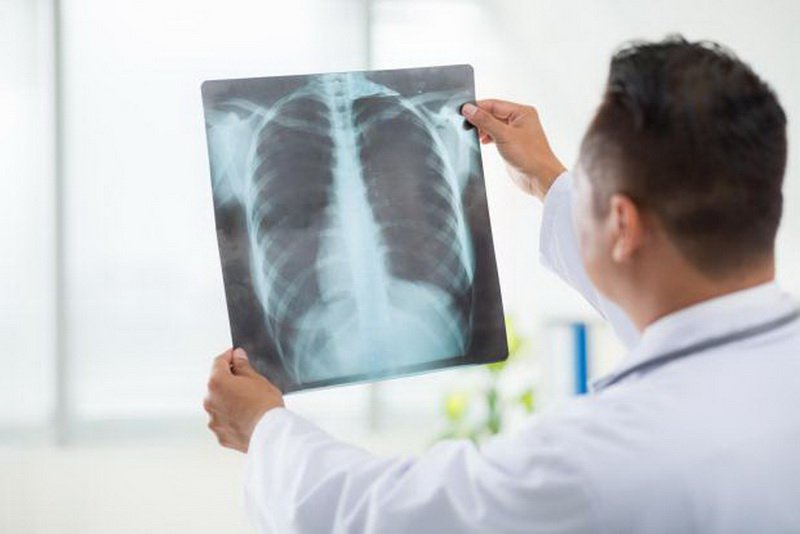 Hình ảnh dải xơ đỉnh phổi trên Xquang phổi nghĩa là gì?