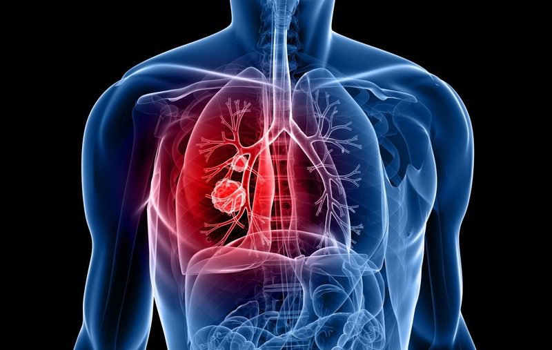 Mắc khối u gần rốn phổi kích thước 37mm có sao không?