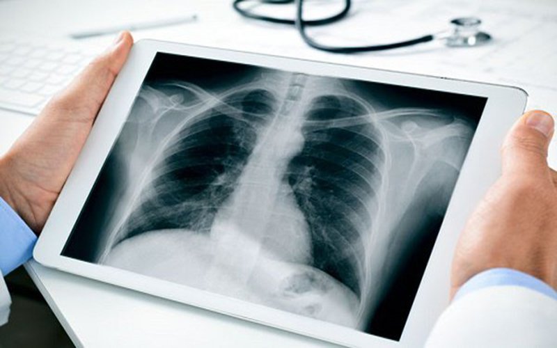 Chụp X quang phổi thấy có vết mờ là dấu hiệu bệnh gì?
