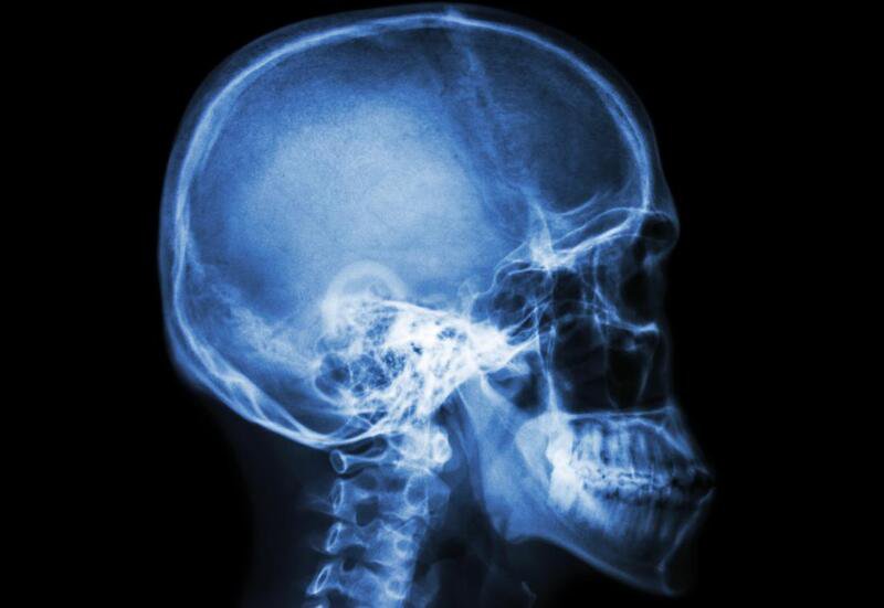 Hình mờ ở xương sọ trên phim X quang nghĩa là gì?