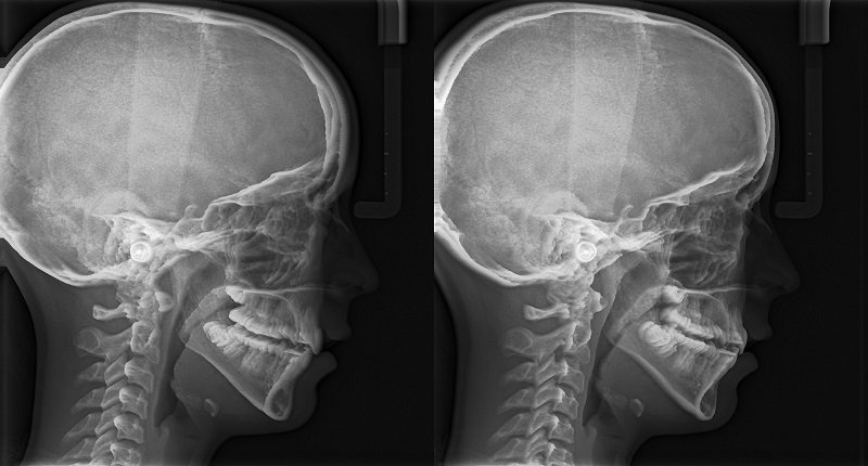 Kết quả X quang sọ khuyết xương sọ hình bản đồ nghĩa là gì?
