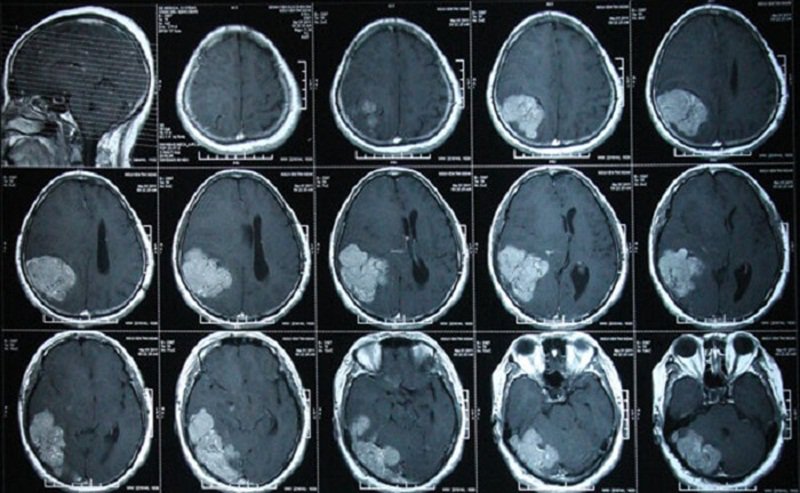 Chụp CT sọ não có tiêm thuốc cản quang chẩn đoán u não được không?