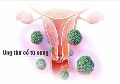Hướng dẫn trực quan về ung thư cổ tử cung
