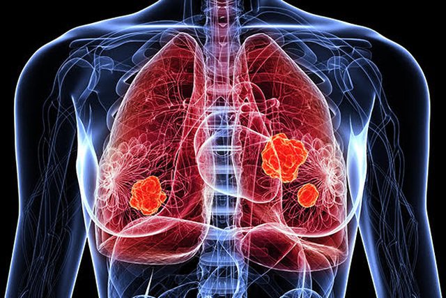 Nguyên nhân gây bệnh ung thư phổi có thể do mức độ ô nhiễm không khí