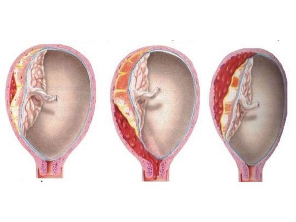 Bóc tách túi thai 25% khi mang thai 8 tuần có sao không?