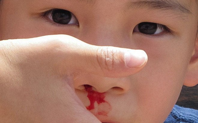 Trẻ 4 tuổi hay chảy máu mũi kèm nhiều gỉ mũi