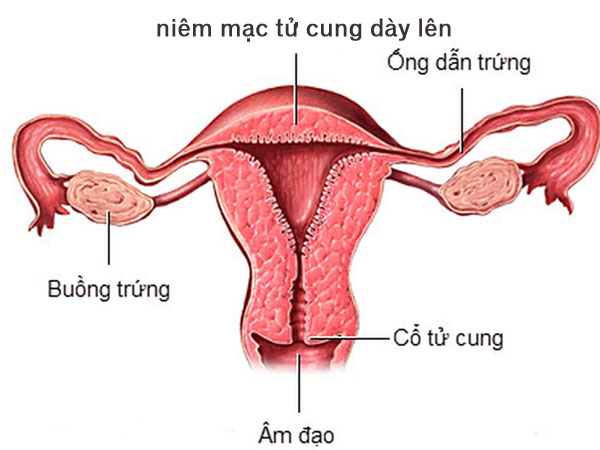 Nữ giới nội mạc tử cung dày 20mm