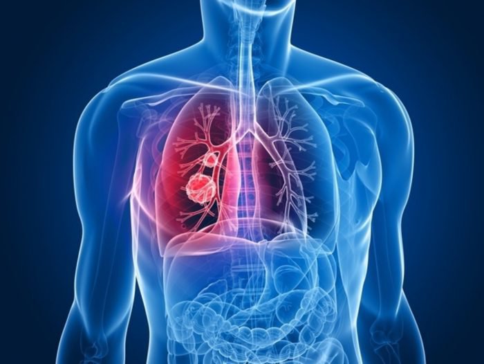 U thùy trên phổi phải có chữa trị được không?