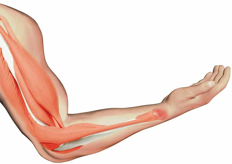 Nam giới dãn cơ tay điều trị như thế nào?