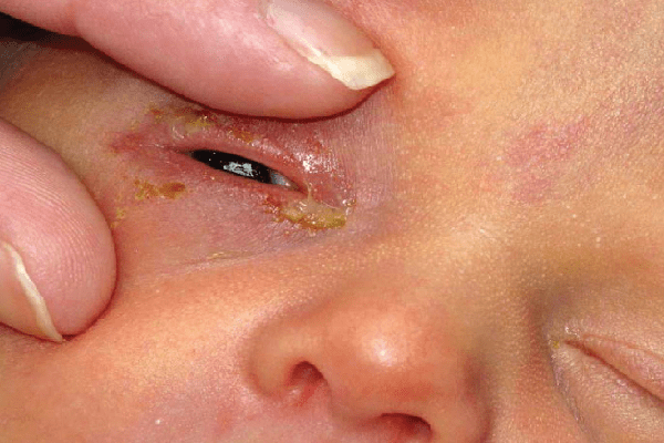 Trẻ sơ sinh bị chảy mủ mắt kèm sưng mí mắt là bệnh gì?