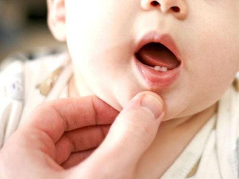 Trẻ 15 tháng có răng mọc bị lợi trùm kèm đen có phải sâu răng không?