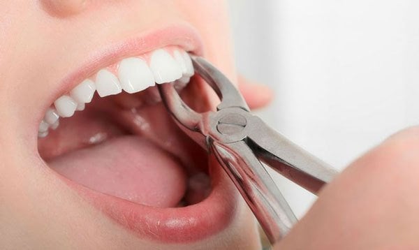 Trồng răng sau khi nhổ răng hàm dưới