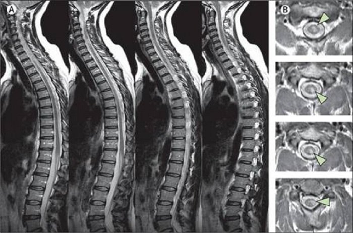 Kết quả chụp MRI đĩa đệm cột sống thắt lưng chuyển màu đen là sao?