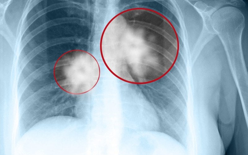 Nam giới phổi có vết mờ có ảnh hưởng gì?