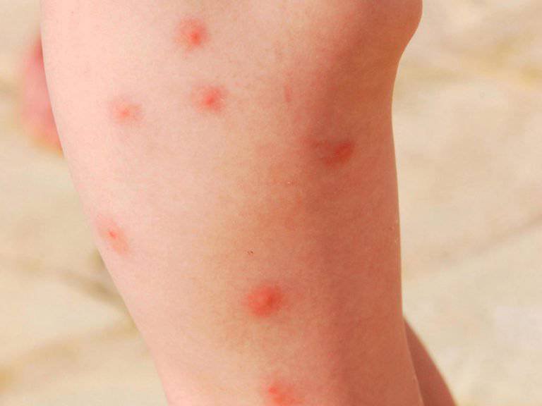 Trẻ hay nổi ngứa mẩn đỏ ở da là dấu hiệu bệnh gì?