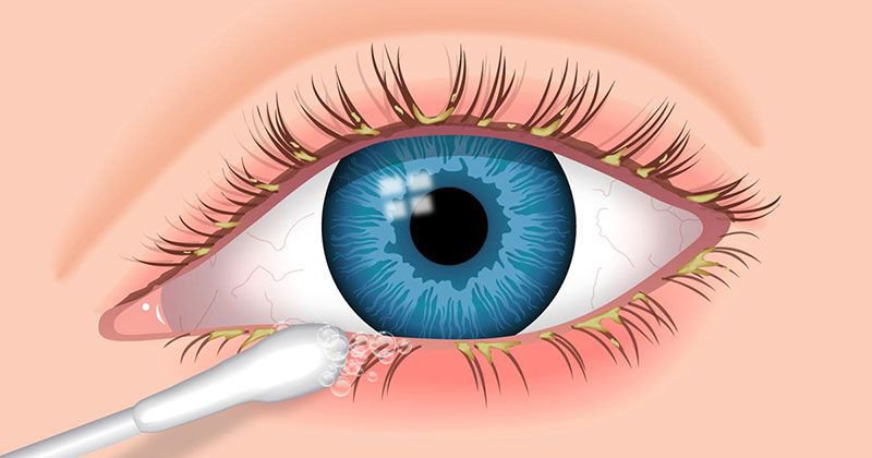 Điều trị viêm bờ mi mắt mãn tính kèm khô mắt bằng thuốc gì?