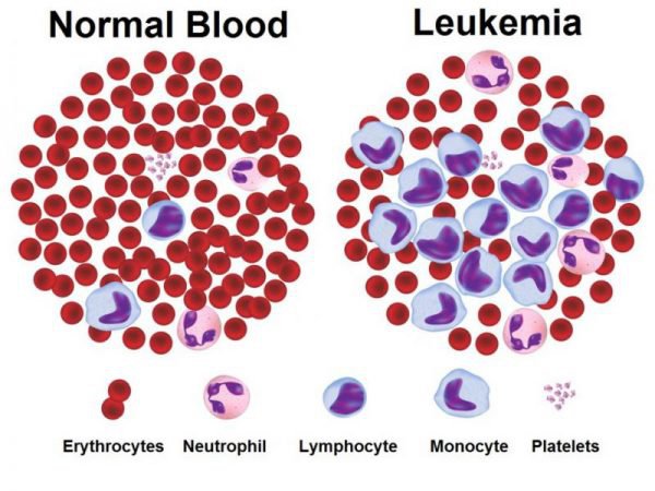 Người bệnh Leukemia cấp tụt tiểu cầu kèm sưng tấy ở chân do đâu?
