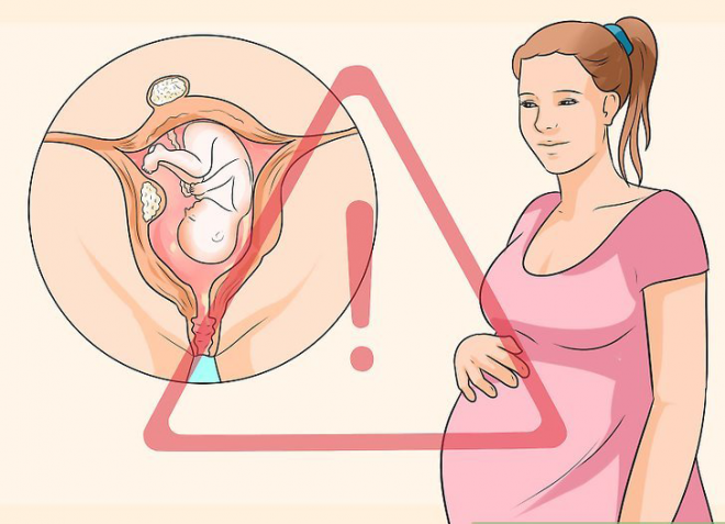 nhân xơ tử cung có ảnh hưởng tới thai nhi