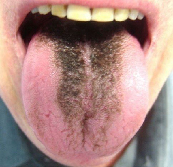 Lưỡi người bệnh có lông đen sẽ biến mất sau khi sử dụng thuốc điều trị