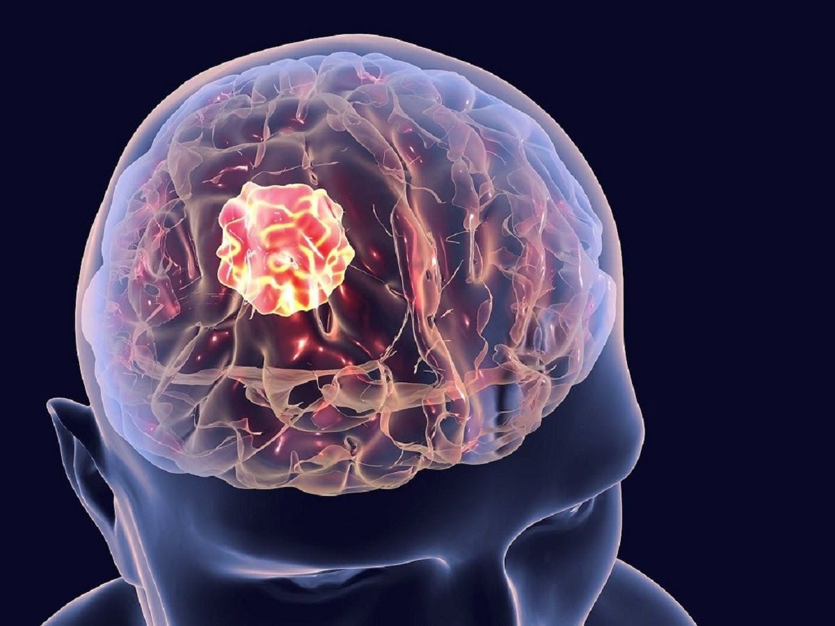 U não là một trong các nguyên nhân gây đau đầu vùng trán và hốc mắt