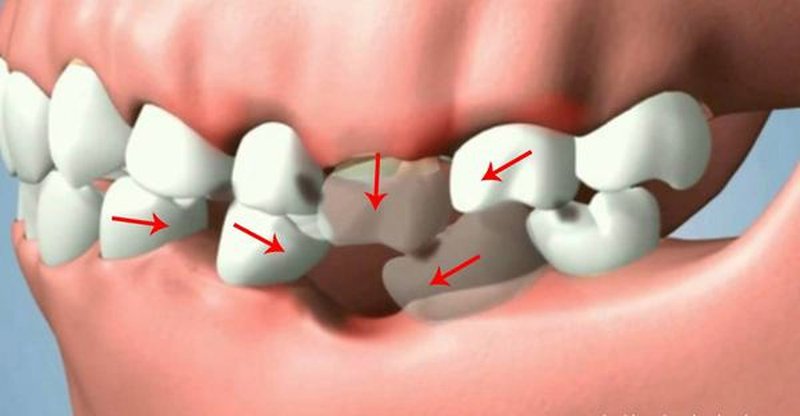 Người mất răng số 6 chưa đủ tuổi trồng implant nên làm gì?