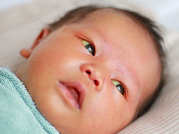 trẻ sơ sinh bị vàng mắt