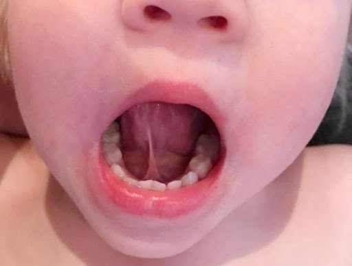 Có thể phẫu thuật cắt thắng lưỡi ngay sau khám nếu phát hiện không?