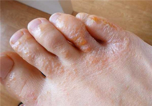 Cách điều trị nấm tổ đỉa ở bàn chân như thế nào?