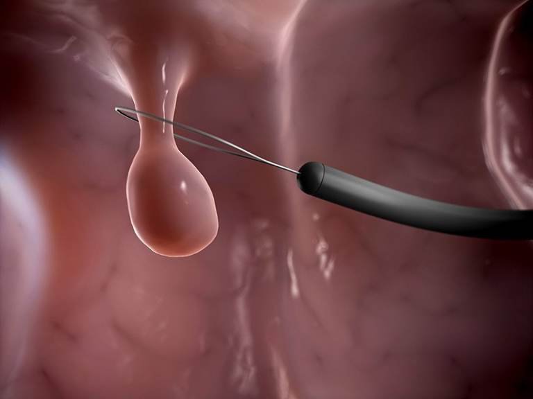 Có nên phẫu thuật cắt bỏ polyp buồng tử cung không?