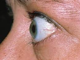 Nguyên nhân lồi mắt kèm giảm thị lực là gì?