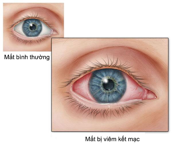 Người bị viêm kết mạc mà mắt dễ kích ứng và tắc tuyến lệ phải làm sao?