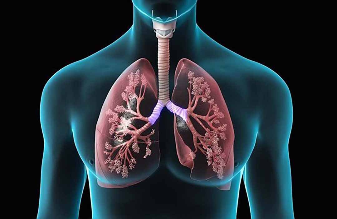 Triệu chứng lao phổi