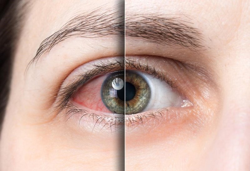 Mỏi mắt kèm lóa mắt sau mổ cận thị