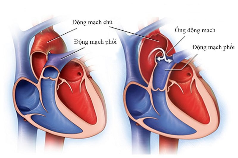 Trẻ có động mạch chủ phải nằm bên trái kèm dính vào cơ tim nguy hiểm không?