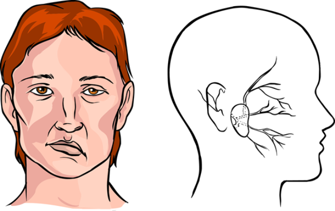 Cơ mặt không tự nhiên sau liệt dây thần kinh số 7 điều trị thế nào?