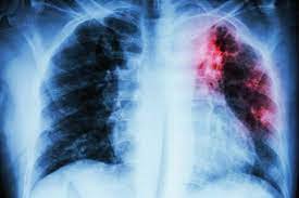 Xơ rải rác 2 phổi có nguy hiểm không?