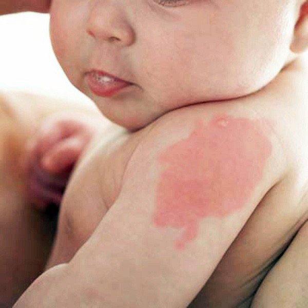 Trẻ 3 tháng tuổi bị u máu điều trị thế nào?
