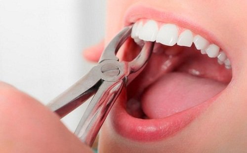 nhổ răng có ảnh hưởng gì không