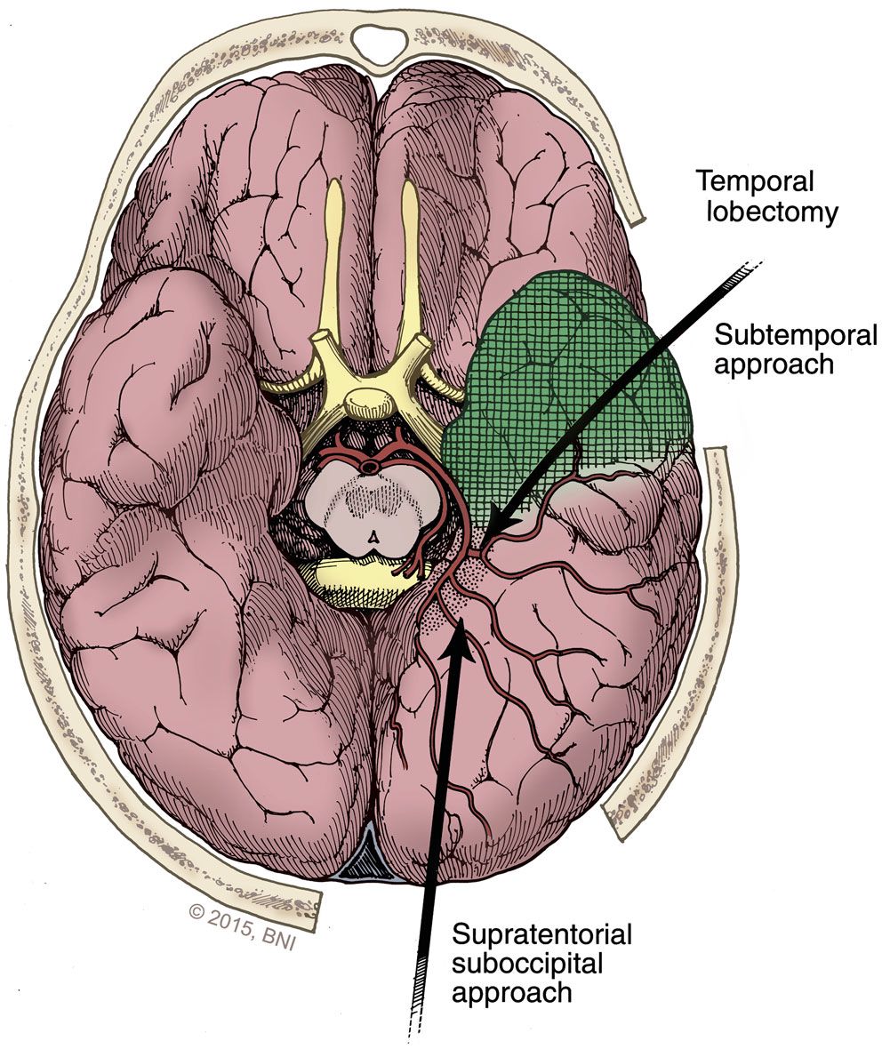 Hình 2. Hình minh hoạ thùy thái dương trước giữa được cắt bỏ (phần màu xanh) (nguồn: Swanson K. I et al., Epilepsy, Functional Neurosurgery, and Pain, Operative Neurosurgery, 2019)
