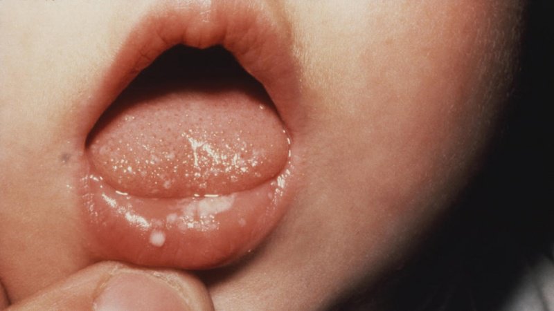 trẻ sơ sinh bị nổi hạt trắng trong miệng