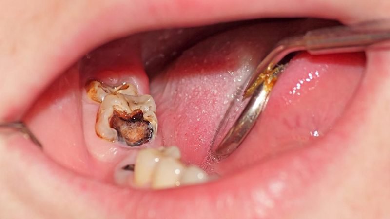 nhổ răng hàm bị sâu