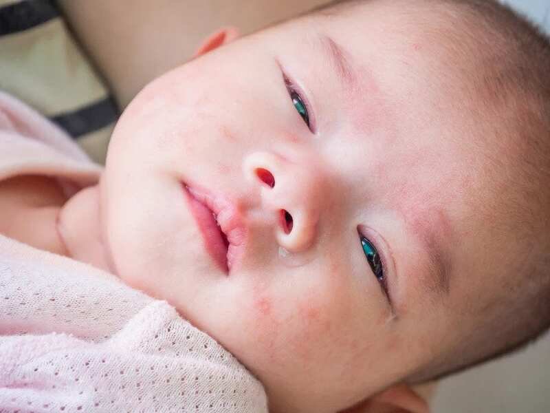 Trẻ 2 tháng tuổi bị viêm da cơ địa tái phát