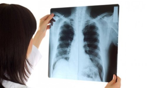 Kết quả X quang phổi có các nhánh phế quản hai bên đậm