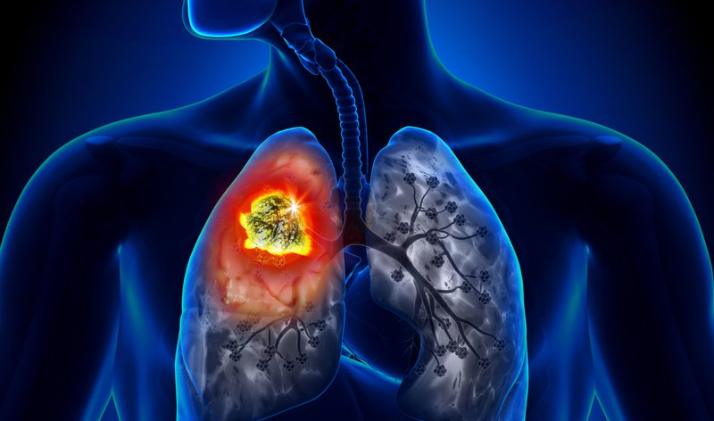 U nang phổi có nguy hiểm không?