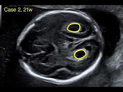 Nang đám rối mao mạch ở thai nhi có nguy hiểm không?