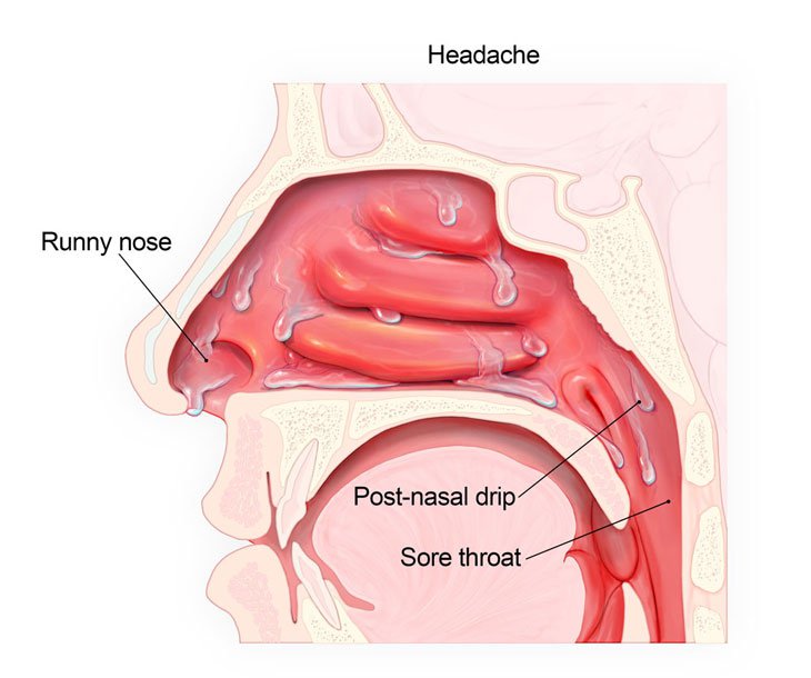 Rối loạn tiết dịch vùng mũi họng