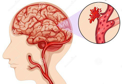 Xuất huyết vùng tiểu não nên uống thuốc gì?